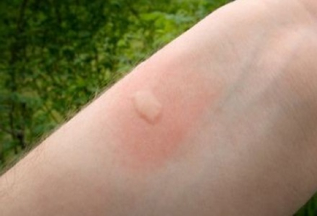 Tips για να απαλλαγείτε απ’ τη φαγούρα του τσιμπήματος των κουνουπιών