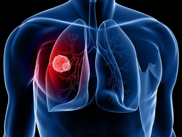 "Θερίζει" ο καρκίνος του πνεύμονα τους Ευρωπαίους