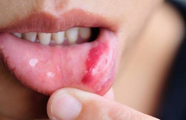 Προσοχή στον ύπουλο καρκίνο του στόματος