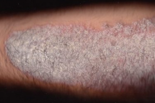 Επιστημονική μέθοδος που μετατρέπει ανοιχτά τραύματα σε υγιές δέρμα