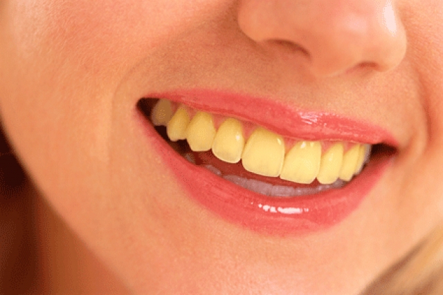 Πως να απαλλαγείτε από τα κίτρινα δόντια